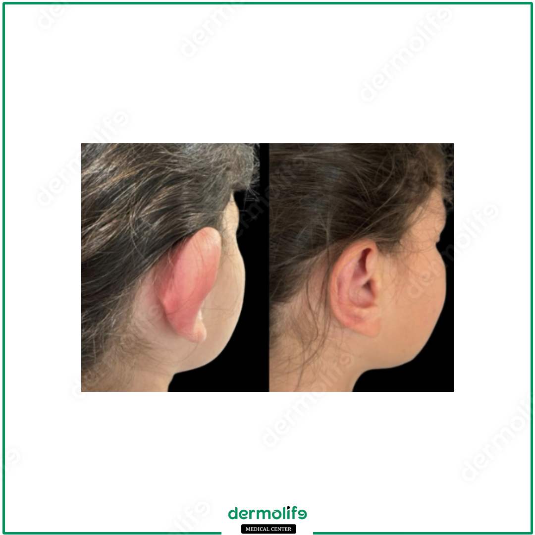 otoplasty aesthetic clinic italy 