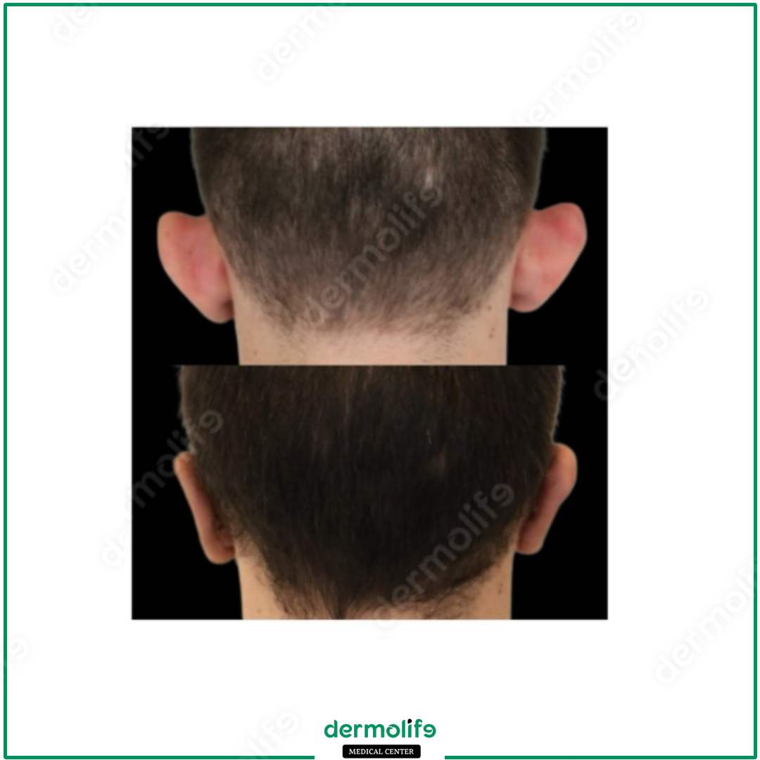 otoplasty aesthetic clinic italy 