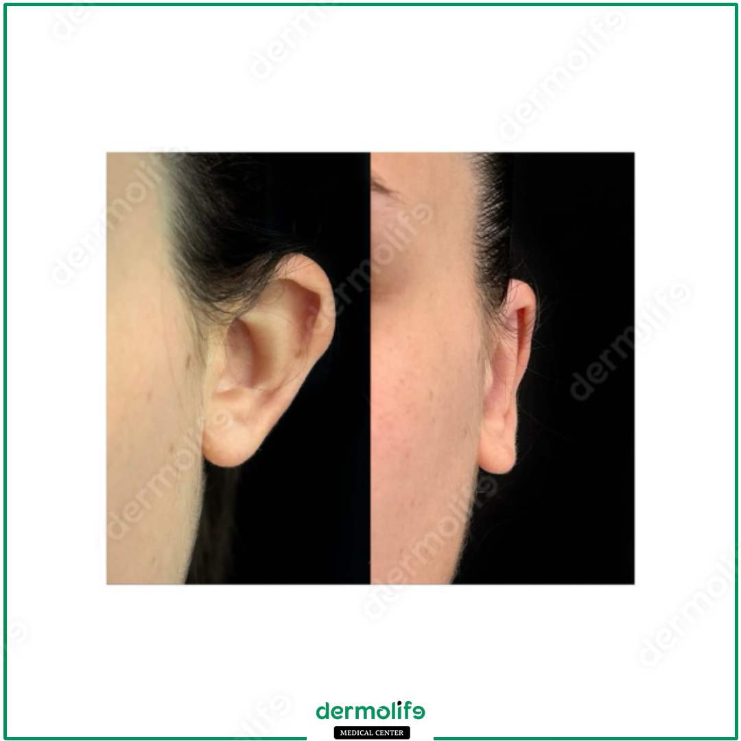 otoplasty aesthetic clinic italy 