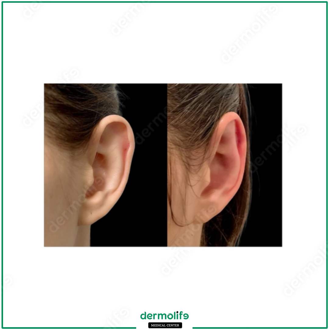 otoplasty aesthetic clinic italy 
