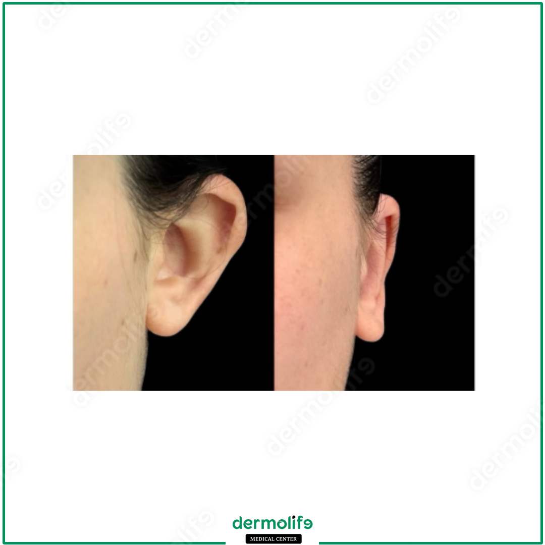 otoplasty aesthetic clinic italy 