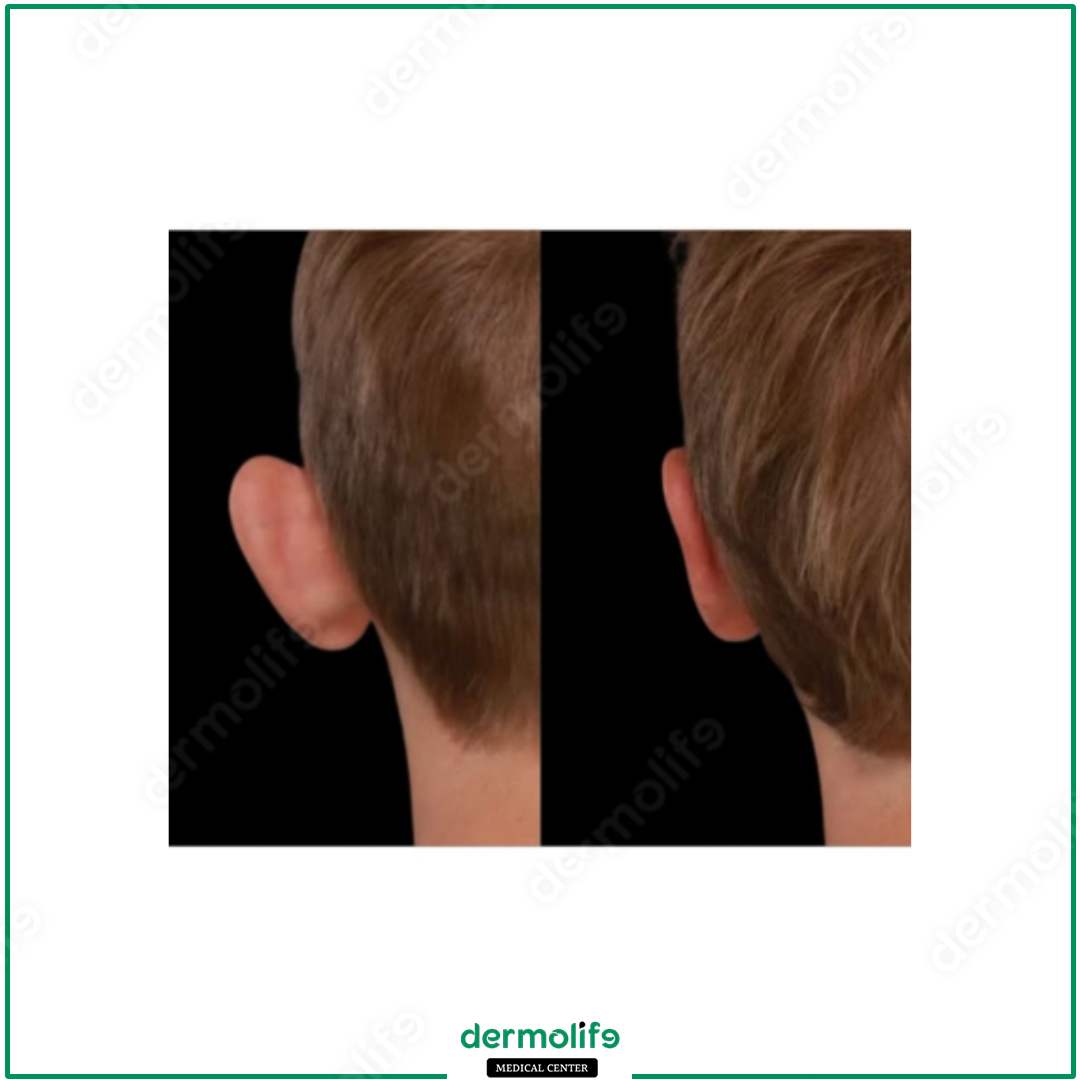 otoplasty aesthetic clinic italy 
