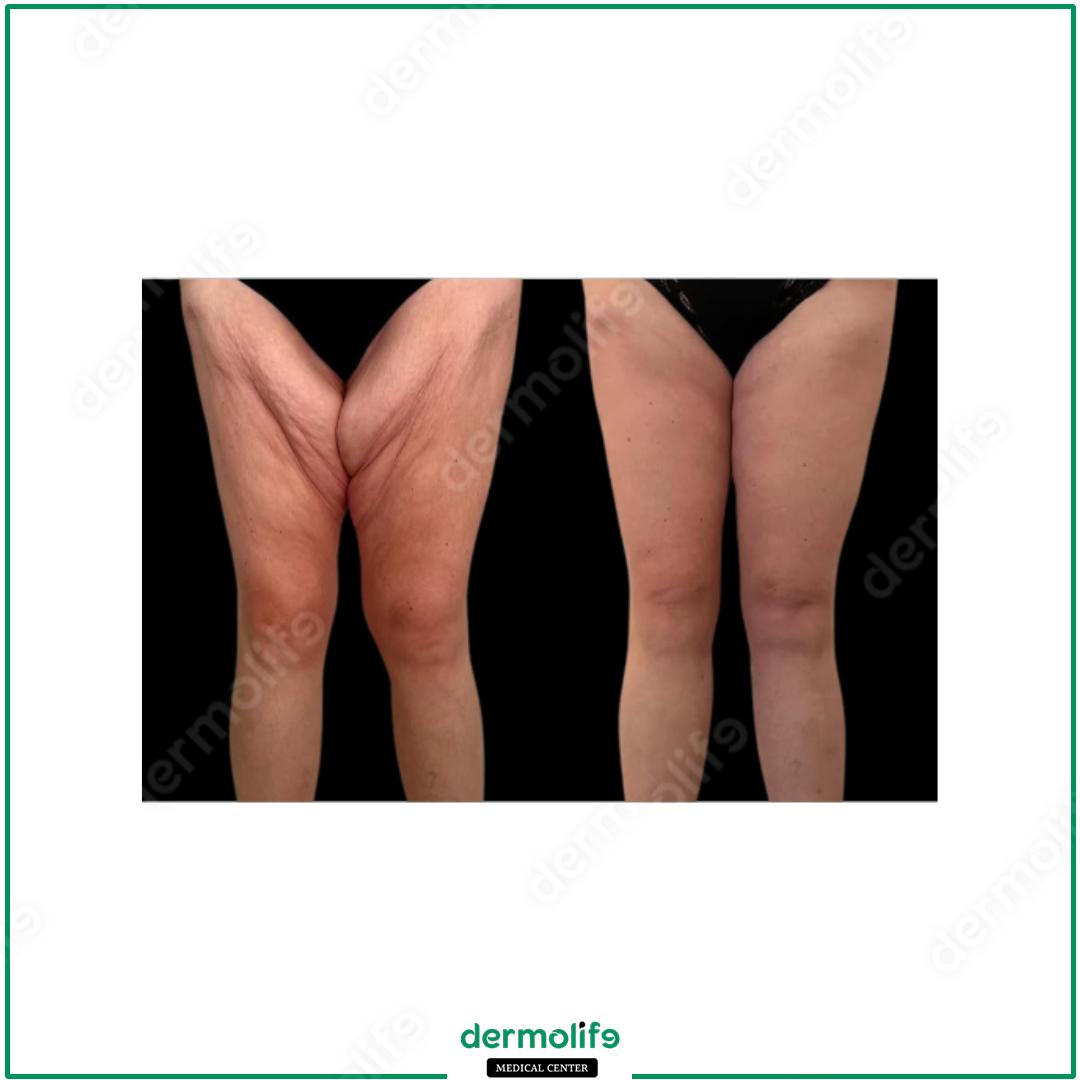 thigh lift aesthetic clinic italy 