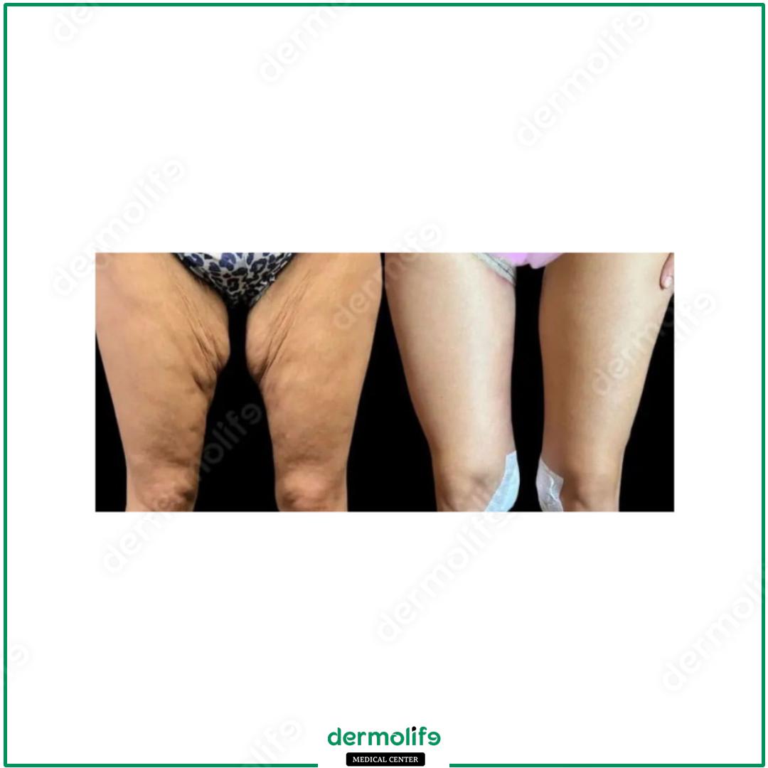 thigh lift aesthetic clinic italy 
