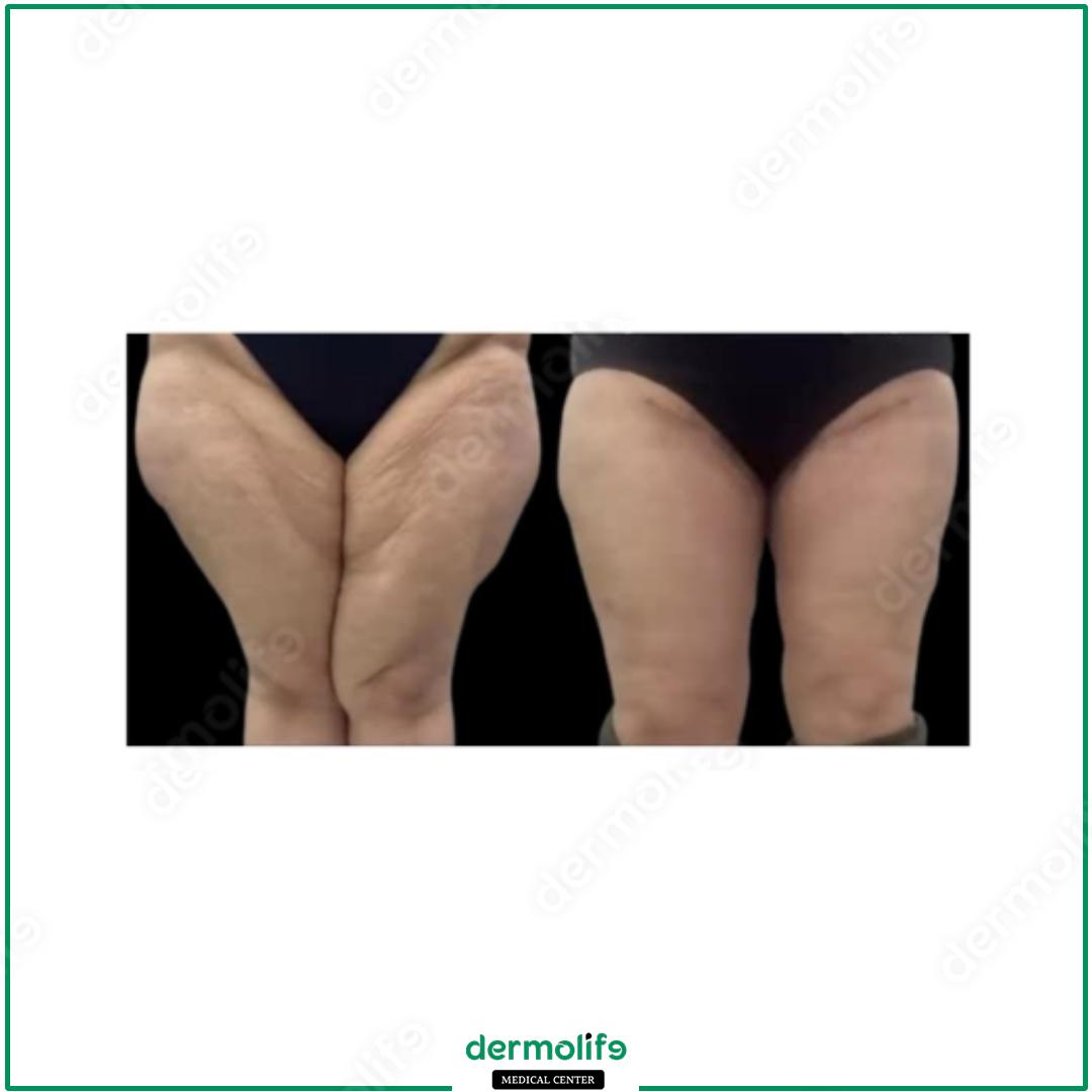 thigh lift aesthetic clinic italy 