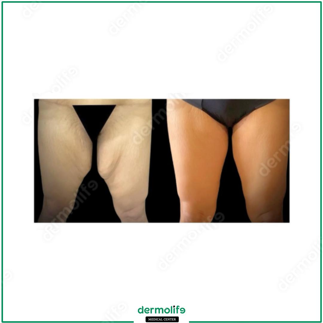 thigh lift aesthetic clinic italy 