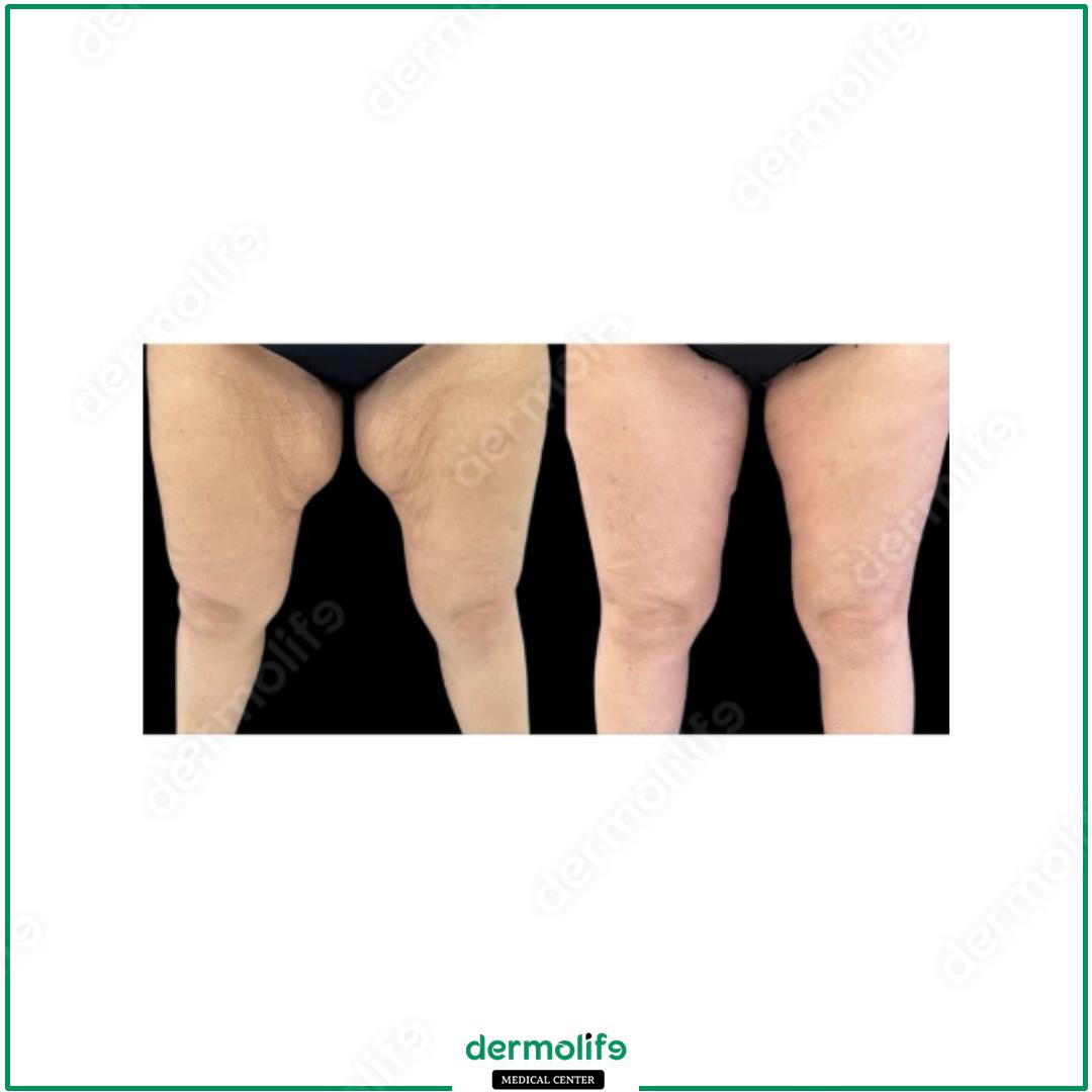 thigh lift aesthetic clinic italy 