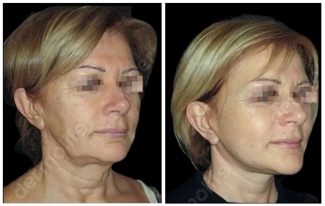lifting-del-viso clinica estetica italy 