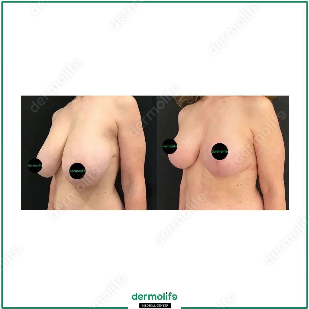 lifting del seno clinica estetica italy 1