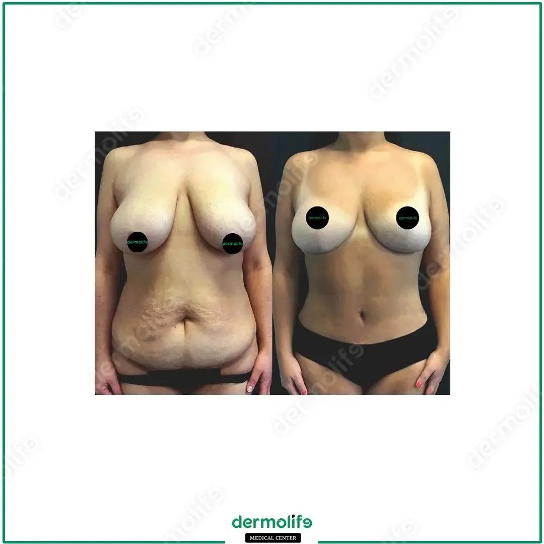 lifting del seno clinica estetica italy 1