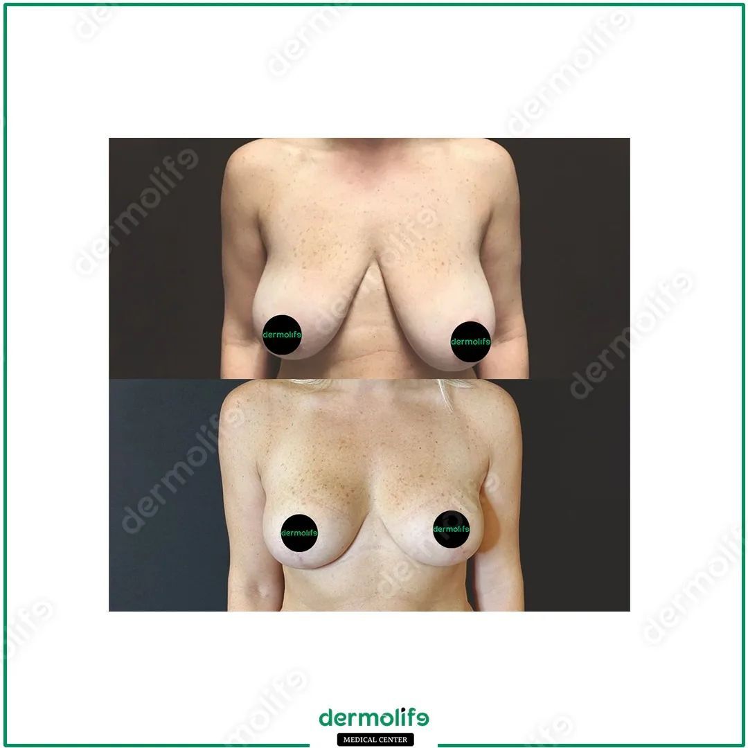 lifting del seno clinica estetica italy 1