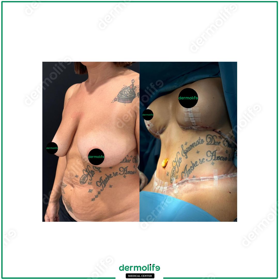 mommy-makeover clinica estetica italy 