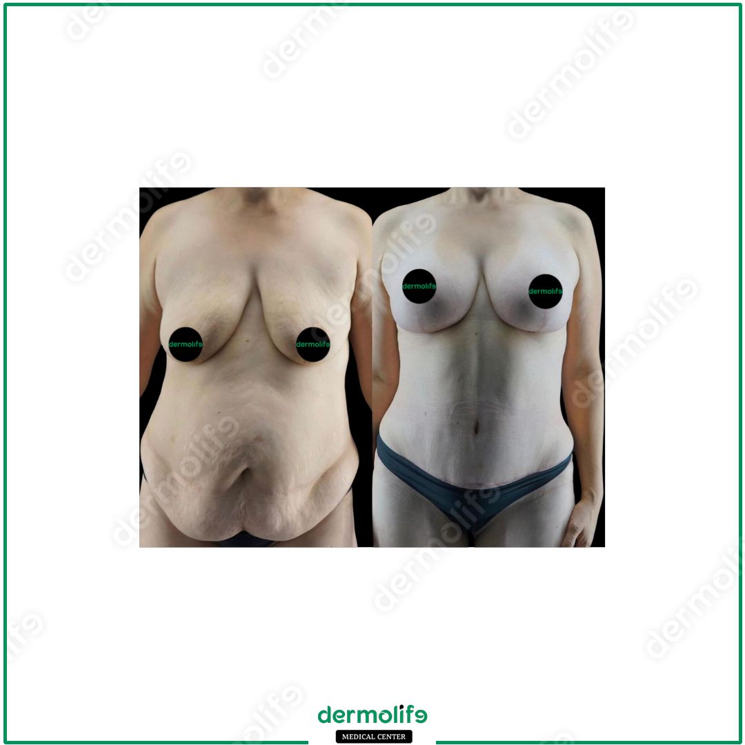 mommy-makeover clinica estetica italy 