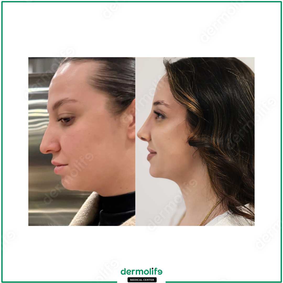 rinoplastica clinica estetica italy 