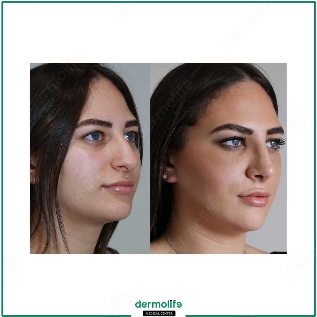 rinoplastica clinica estetica italy 