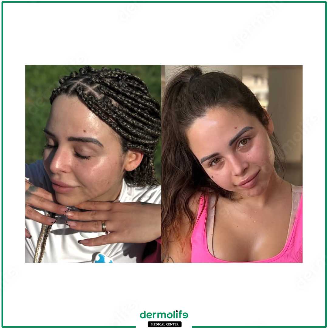 rinoplastica clinica estetica italy 