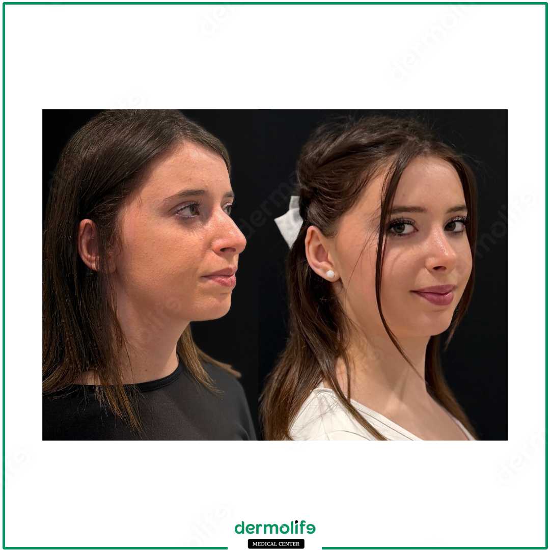 rinoplastica clinica estetica italy 