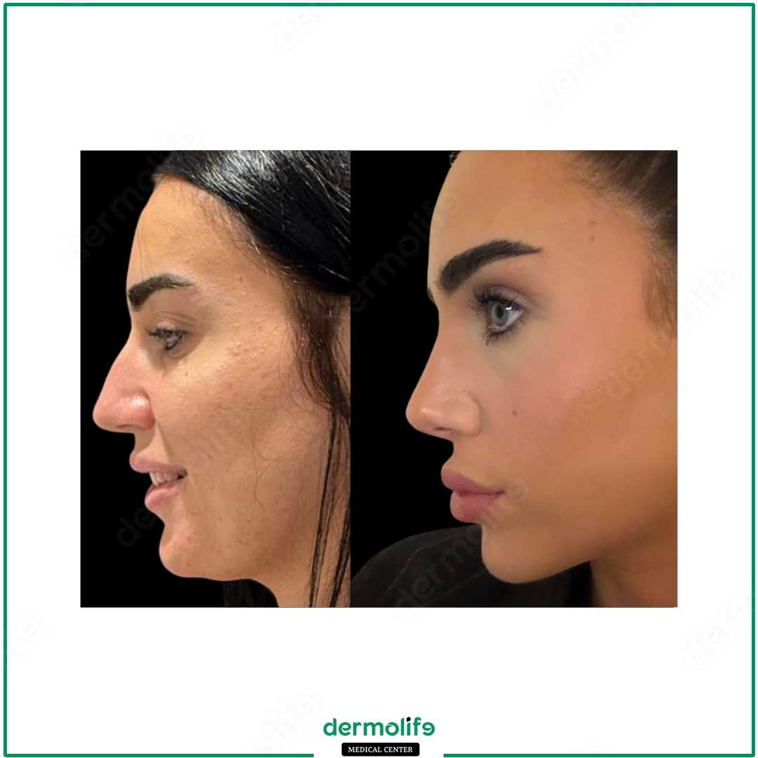 rinoplastica clinica estetica italy 