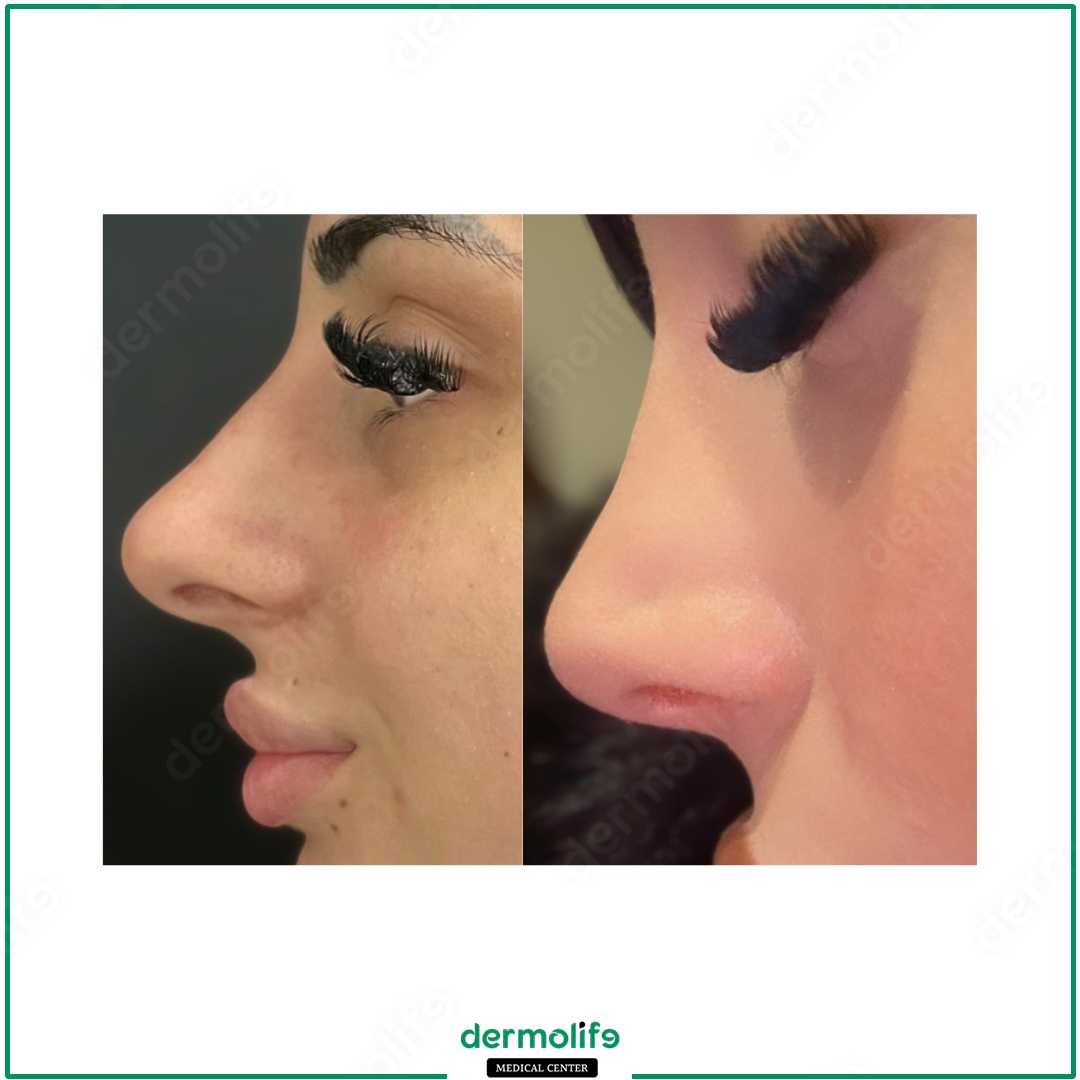 rinoplastica clinica estetica italy 