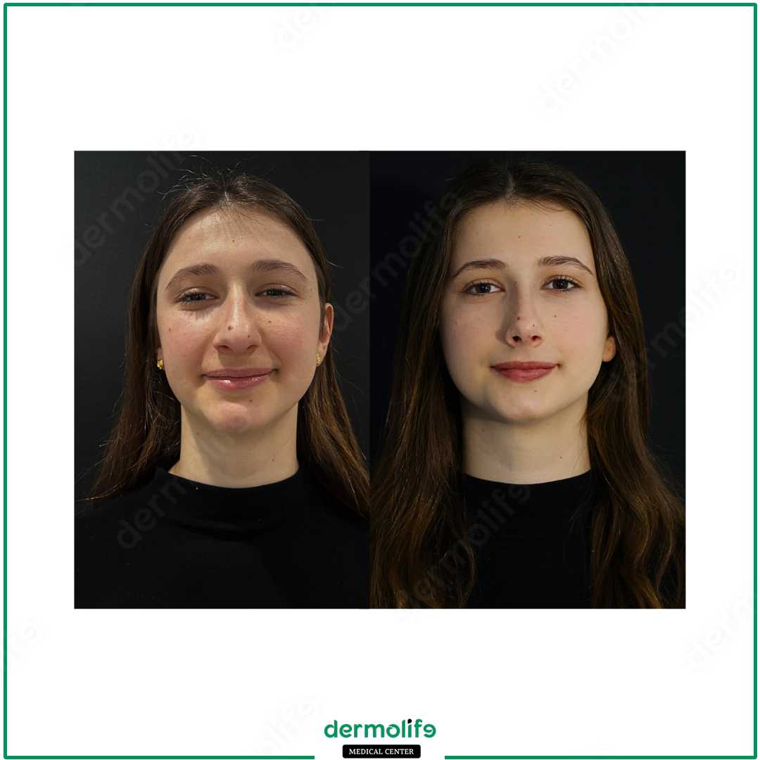 rinoplastica clinica estetica italy 